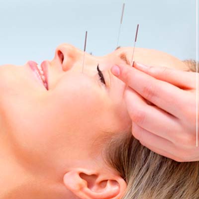 acupuntura en soller